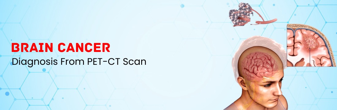 PET-CT Scan for Brain Cancer